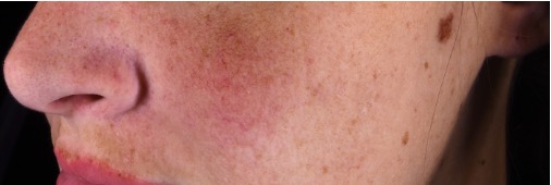 CALMELYS - Photo in vivo site internet AFTER