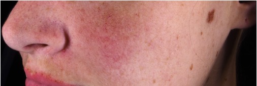 CALMELYS - Photo in vivo site internet BEFORE