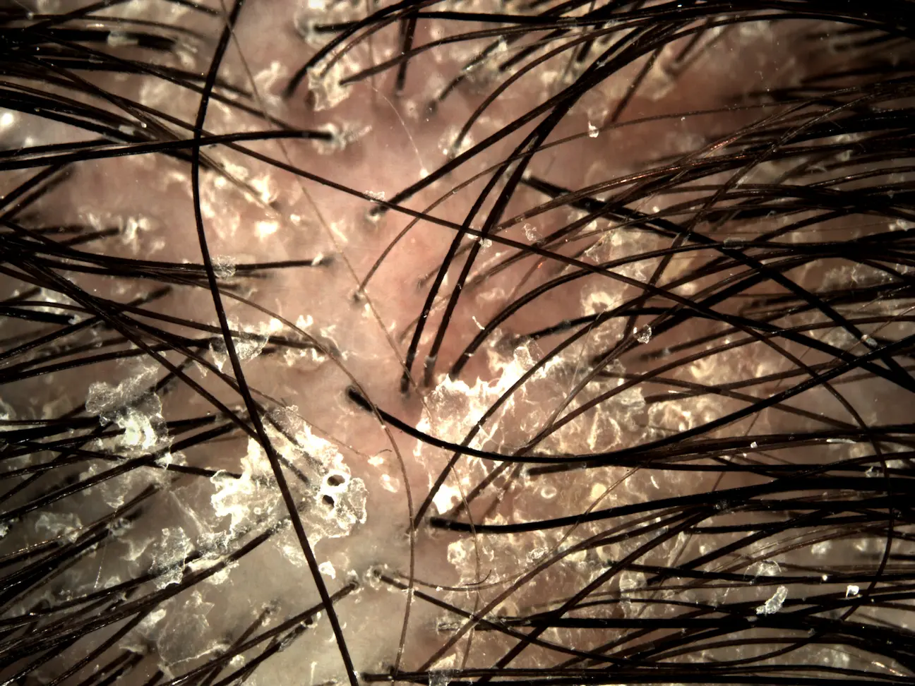 SCAPILYA - Photo dandruff D0 (vol. 8)