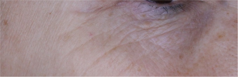 SUNGLOWER - Photo in vivo site internet BEFORE